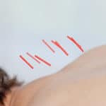 do acupuncture needles hurt
