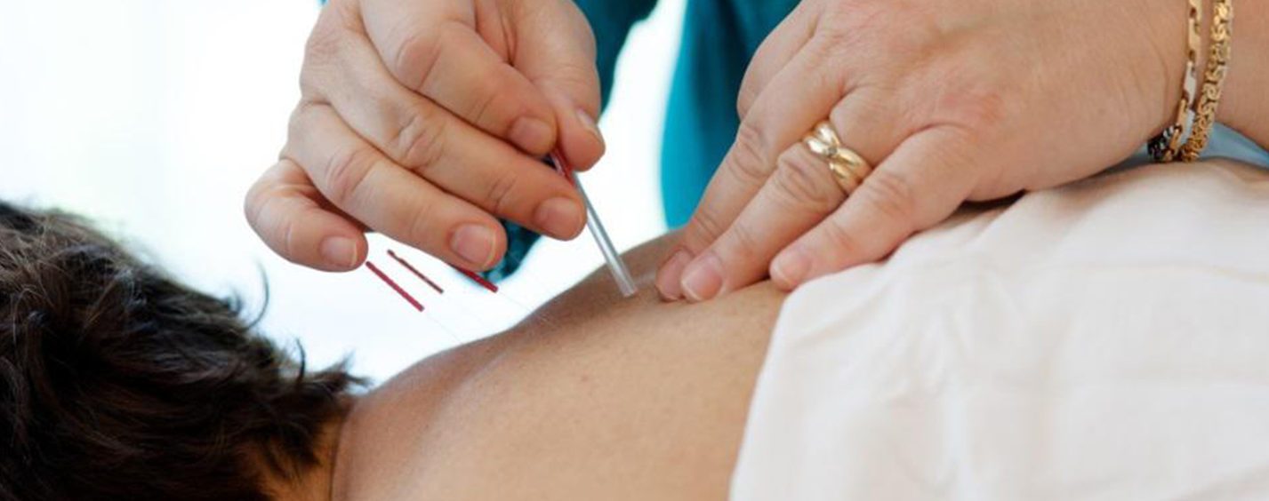 acupuncture for pain management
