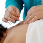 car accident acupuncture