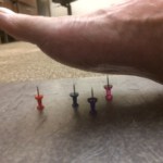 Can acupuncture help neuropathy